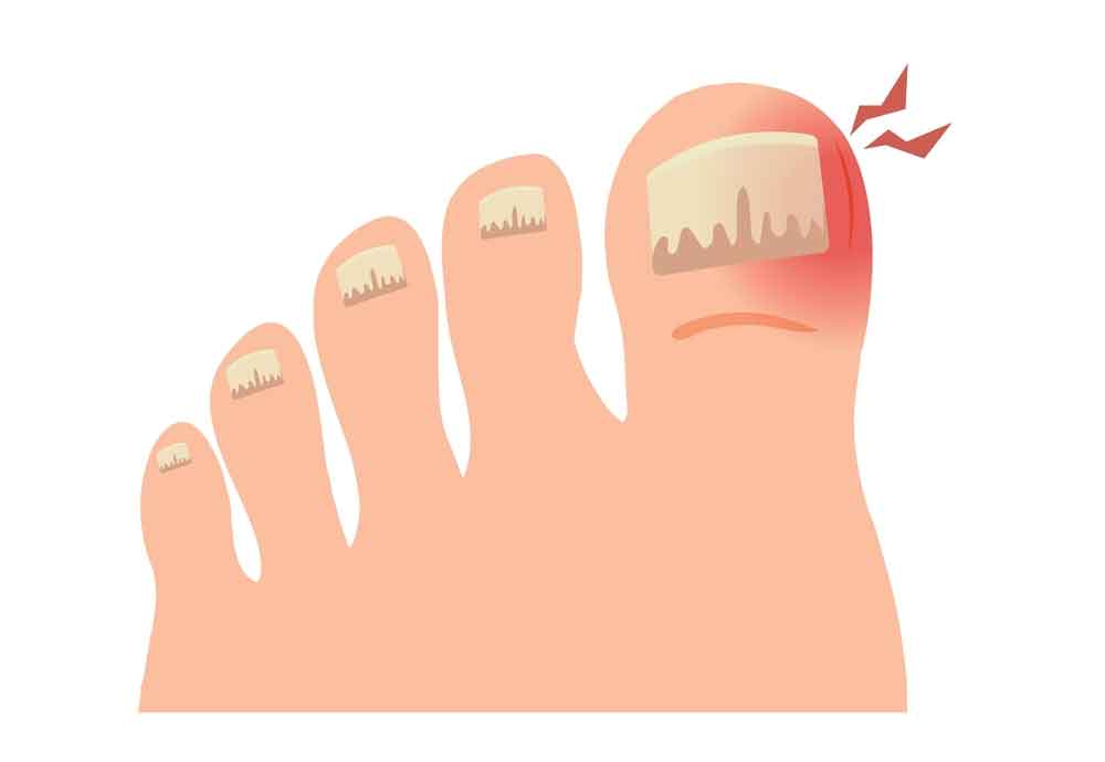 toenail-fungus-home-remedy-white-vinegar-vs-apple-cider-vinegar